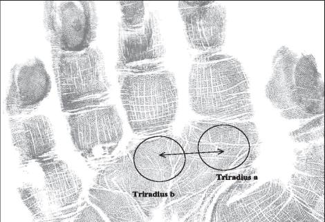 Figure 1: Sydney and Simian lines (courtesy modern hand reading forum).