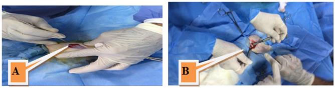 Figure 1: A. Induce surgical incision at the lateral aspect on thigh. B. Expose femoral bone.