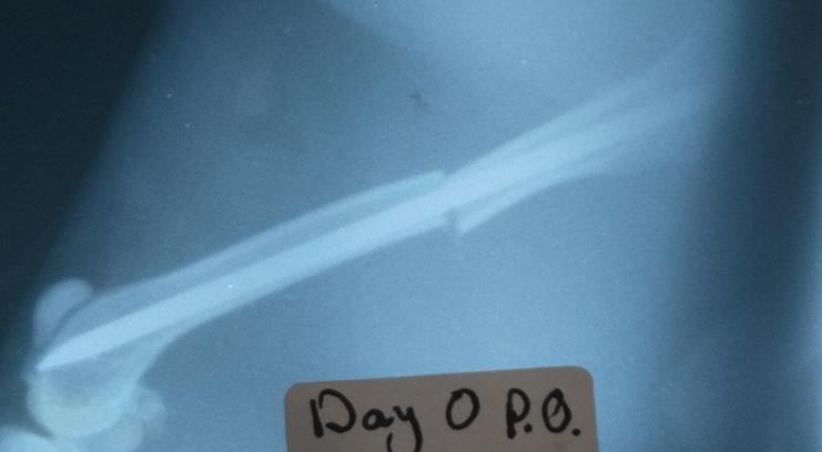 Figure 4: Radiographic image immediately after induced femoral transverse fracture shows well fixation, with visible and sharp end of fracture line.