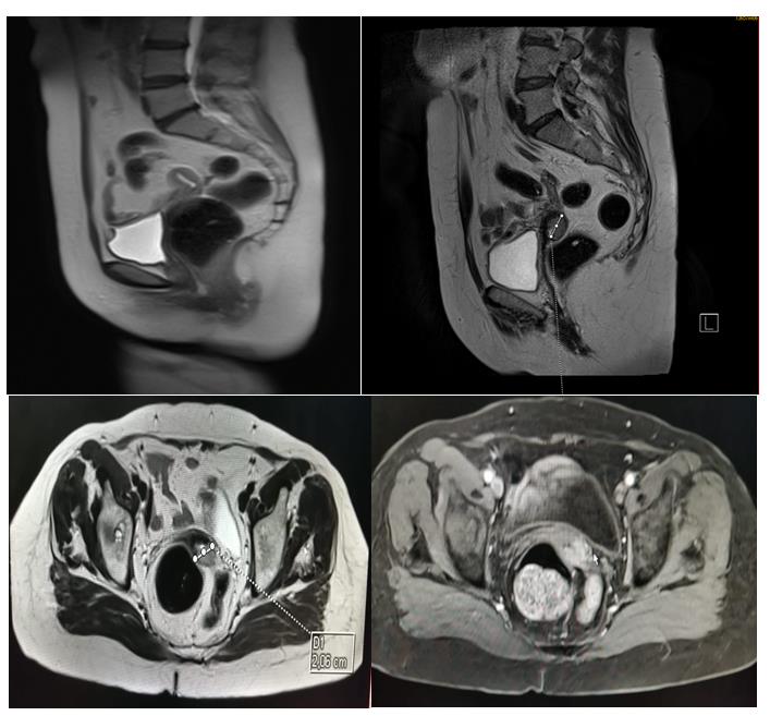 Figure 1: Sagittal and axial section of pelvic MRI in sequence T2, T1 FAT-SAT with contrast injection showing a tumor process on the right posterolateral side of the cervix, stage IB2 according to FIGO 2018 classification.
