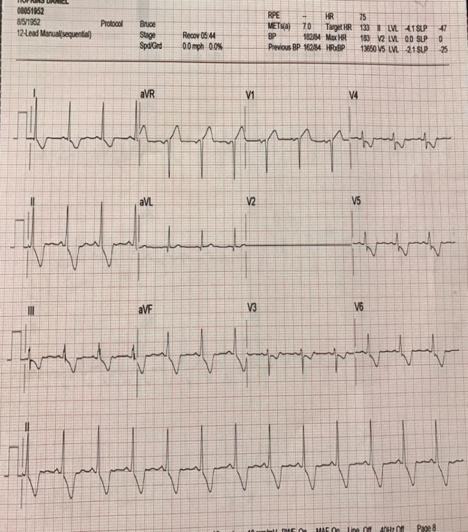 Figure 3: Almost 6 minutes into recovery: Marked ST elevation in aVR and also V1 and worsening downsloping ST depression inferolaterally persist.
