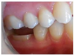 Figure 3: Buccal view of the butt join margin.
