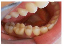 Figure 4: Occlusal view of the provisional restoration.