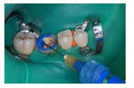 Figure 8: Treatment of the inner surface of the tooth after protection with a Rubber Dam: Etching with orthophosphoric acid then applying a thin layer of adhesive.