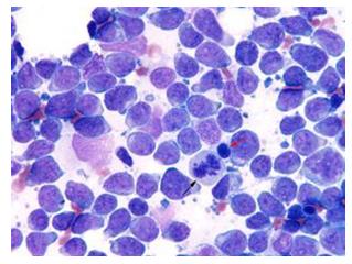 Figure 14: Extramedullary hematopoiesis showing all the myeloid and lymphoid elements in splenic mass.