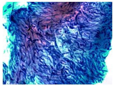 Figure 15: Epithelioid granuloma with AFB positivity in ZN stain.