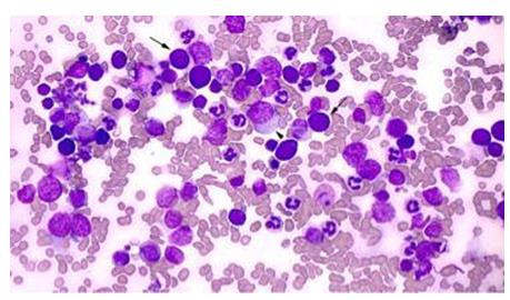 Figure 18: Typical wrinkled paper macrophages in BM Biopsy.