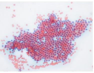 Figure 27: Note the pseudopapillary font without fibrovascular core.
