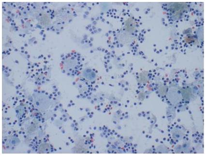 Figure 28: Malignant ductal epithelial cells of ductal adenocarcinoma of pancreas.