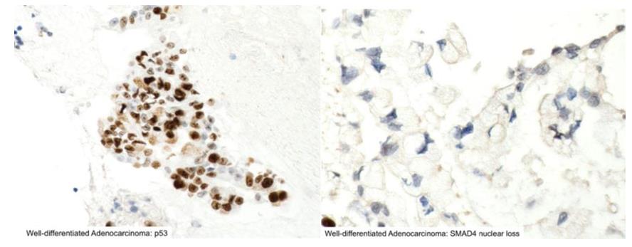 Figure 32: Features of powdery chromatin and small inconspicuous nucleoli.