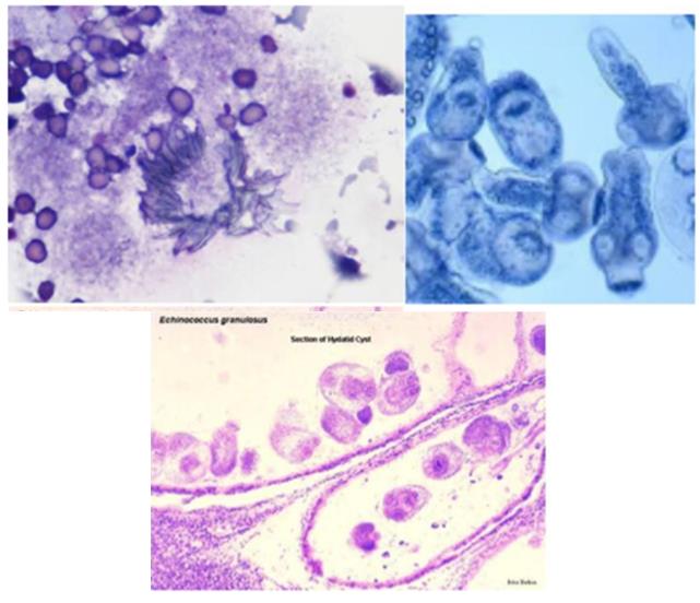 Figure 4: Focal nodular hyperplasia cyto and histo image. Other non-neoplastic lesions: Nodular extramedullary hemopoiesis occurs typically in the setting of myeloproliferative disease and is recognized by the criteria of the triple cell lines-normoblasts, promyelocytes and megakaryocytes.