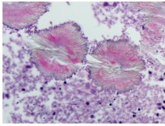 Figure 40: Keratinizing and non-keratinizing squamous cell carcinoma.