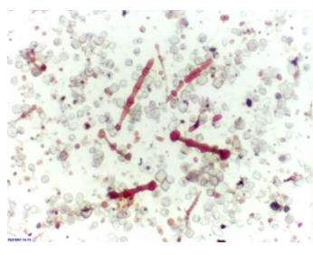 Figure 41: A- Shows monomorphic population of malignant cells(upper left); B- Shows vesicular nuclei and small prominent nucleoli and fine delicate cytoplasm(upper right); C- Shows mild pleomorphism and intracytoplasmic mucin (lower left); D- Shows hobnailing of malignant cells with giant cell in the left side(lower right).