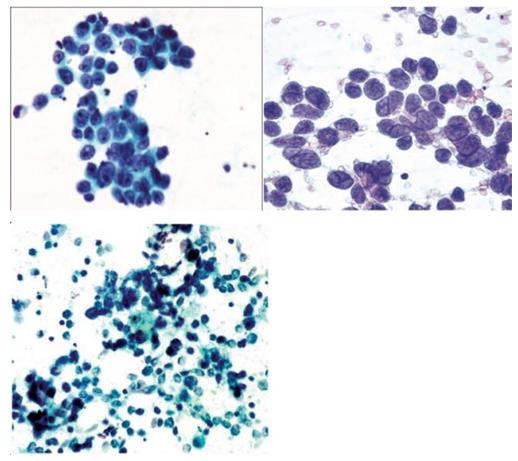 Figure 47: Thyroid FNAC shows same morphology of renal mass consistent with carcinoid with chromogranin A +.