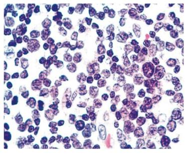 Figure 48: Metastatic colorectal adenocarcinoma. Inflammatory myofibroblastic tumor (IMFT): Loose collection of large mesenchymal cells with rounded nuclei, binucleation, prominent nucleoli and dense cytoplasm. Background of lymphocytes and plasma cells. **Other primary lesion of lung** **Pulmonary hamartoma** [56-59]: Most common benign tumor like condition of lung, • Mature cartilage, • Myxoid connective tissue/’immature cartilage’, • Sheets of entrapped bronchiolar/alveolar epithelium and fat. All the above favors the diagnosis.