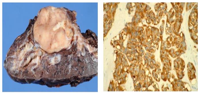 Figure 49: FNA shows mature and immature cartilage components.