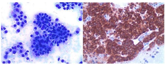 Figure 51: Mesothelioma covering entire pleural surface) (typical bi and multi nucleation in cytology smear.