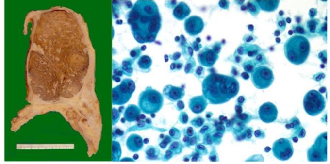 Figure 55: Benign and malignant SFT respectively)(note the heterogenous appearance of image 2.