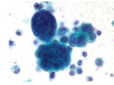 Figure 56: Monomorphic spindle cells with collagenous stroma.