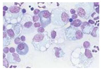 Figure 6: Large hepatobiliary cystadenoma causing obstructive jaundice.