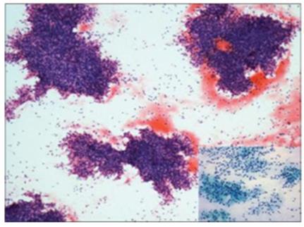 Figure 60: Squamous cell carcinoma and adenoid cystic carcinoma of thymus.