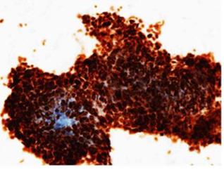 Figure 61: A typical epithelial cells in thymic carcinoma with admixed lymphocytes.