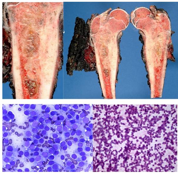 Figure 63: Ganglioneuroma vs ganglioneuroblastoma- ganglion cells with undifferentiated round neuroblastoma component.