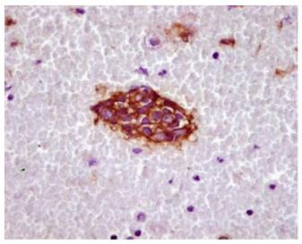 Figure 64: Multi-nucleated and classical RS cells in HL.