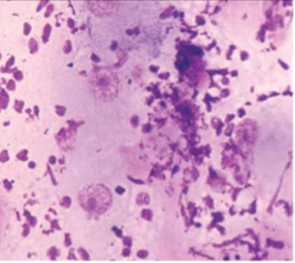 Figure 67: ALK + cells in ALCL.