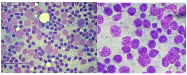Figure 70: Malignant teratoma of testis, sheet of poorly differentiated malignant cells; cytological preparation (Haematoxylin and eosin).