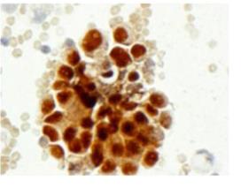 Figure 71: Cytology and cell block preparation from seminoma.