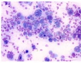 Figure 72: Tumor cells in loose cluster with open chromatin, prominent nucleoli and finely vacuolated cytoplasm.