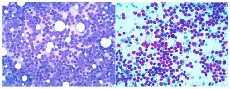 Figure 73: Simple renal cyst cytology shows only macrophages.