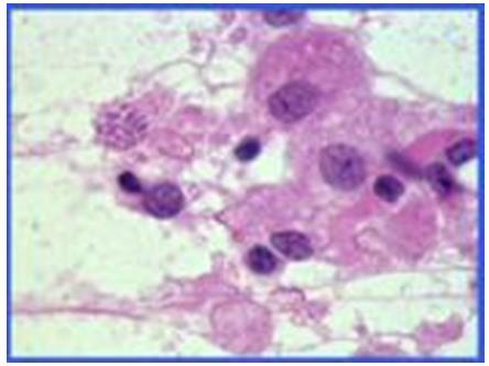 Figure 83: CDC invoking kidney and pelvis. Xp11.2 Translocation Carcinoma: Xp11.2 translocation carcinoma has recently been separated from clear cell RCC on the basis of cytogenetic findings. It is most common in children but also occurs in adult patients and has a very aggressive behavior [96]. The histological features are a mixed pattern of clear cell and papillary components, prominent vascularity and in some cases hyaline globules and psammoma bodies. Positive nuclear staining for TFE3 and melanotic variants also reported (Figure 84).