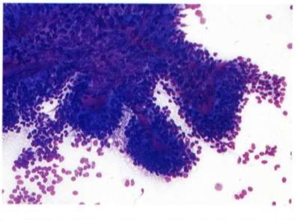 Figure 85: Glomeruloid like structure in metanephric adenoma & resettes like appearance.
