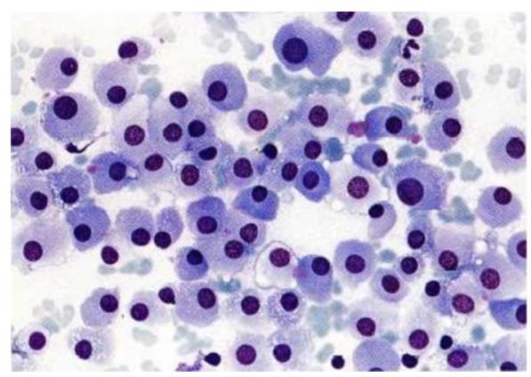 Figure 88: Clear architecture of triphasiccomponents (epithelial, mesenchymal and blastemal) in FNA.