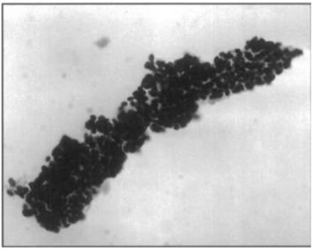 Figure 91: Morphology of all 4 smear clearly shows crowding, overlapping, high N:C ratio, pleomorphism and cercariform cells, and papillae.