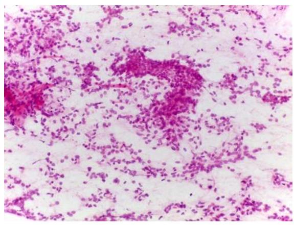 Figure 93: Pericytes which are malignant in nature and also intervening vessels.