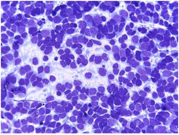 Figure 94: Contents of lymphangioma (both lymph and blood) in FNA.