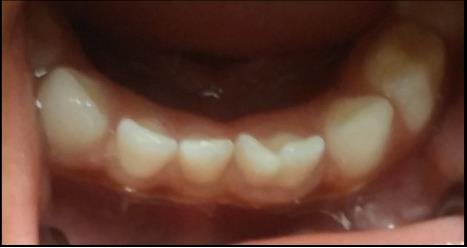Figure 13: Clinical photograph showing fusion of mandibular primary central and lateral incisor.