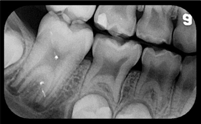 Figure 2: Right bitewing radiograph demonstrating Taurodontism of primary and permanent mandibular molars.