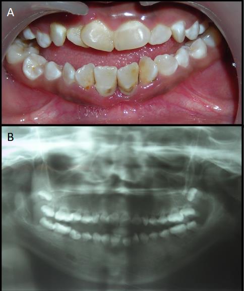 Figure 3: Clinical photograph (A) and panoramic radiograph (B) of a generalized non-syndromic short root anomaly in a 15-year-old patient.