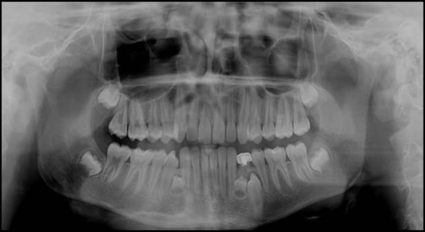 Figure 4: Hyperdontia with supernumerary premolars between mandibular permanent lateral incisor and canines.
