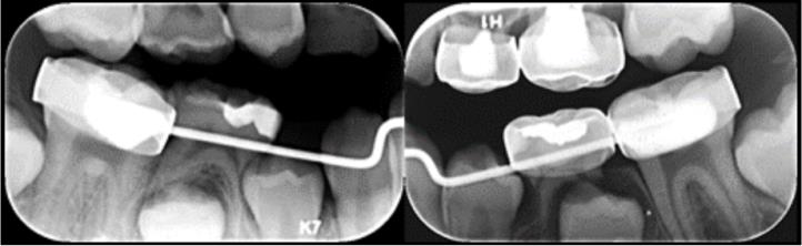 Figure 9: Bitewing radiographs showing distally displaced second premolars.