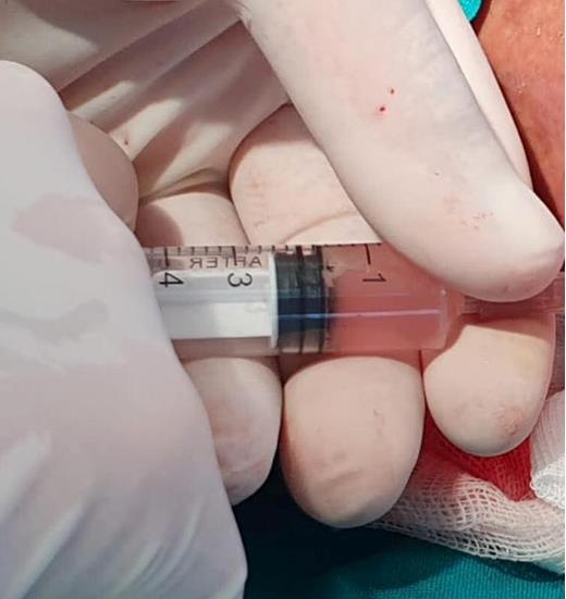 Figure 3: The suspension riches in mesenchymal stem cells are injected into the dermis.
