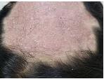 Figure 2: Microsporic tinea due to _M. canis._