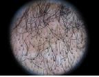 Figure 4: Dermoscopic findings, comma and corkscrew hairs.