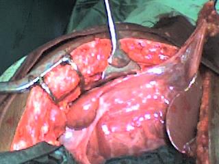 Figure 4: Intra-op picture of one of resectable PLCC.