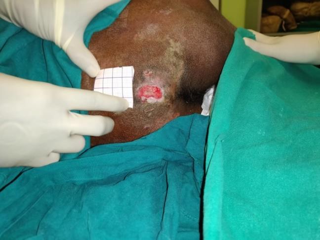 Figure 2: Insulin therapy over healing wound
