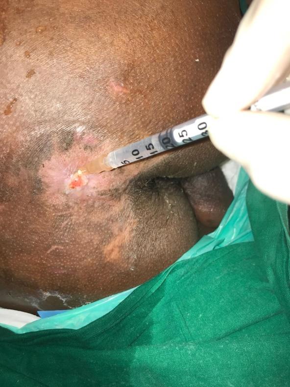 Figure 3: Well healed scar